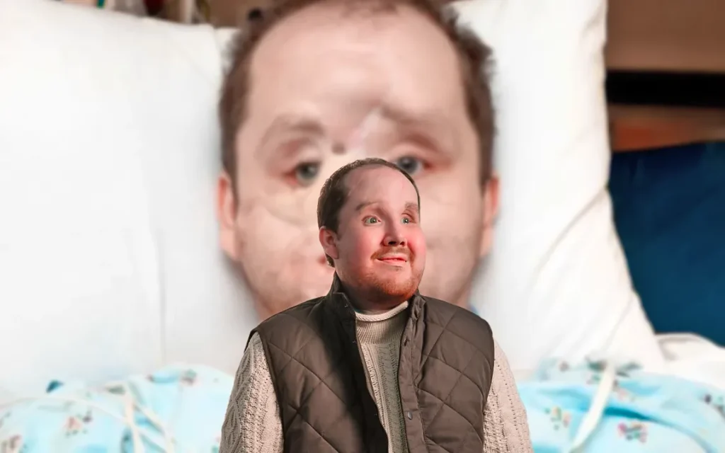 michigan-man-finds-new-life-after-groundbreaking-face-transplant