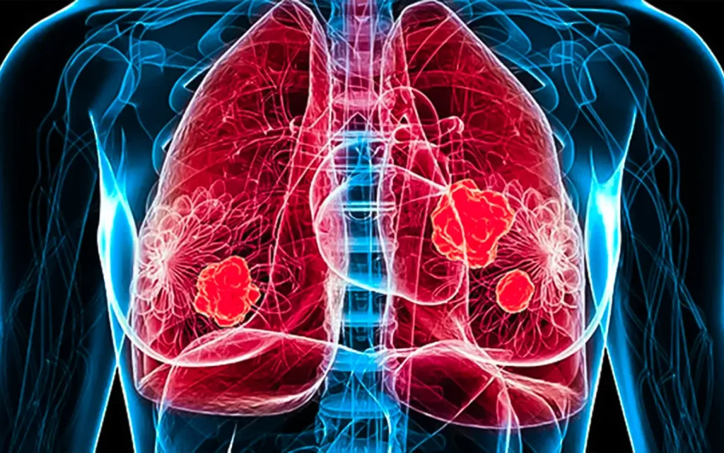 rising-lung-cancer-rates-among-women-an-urgent-call-for-research