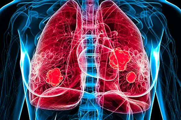 rising-lung-cancer-rates-among-women-an-urgent-call-for-research