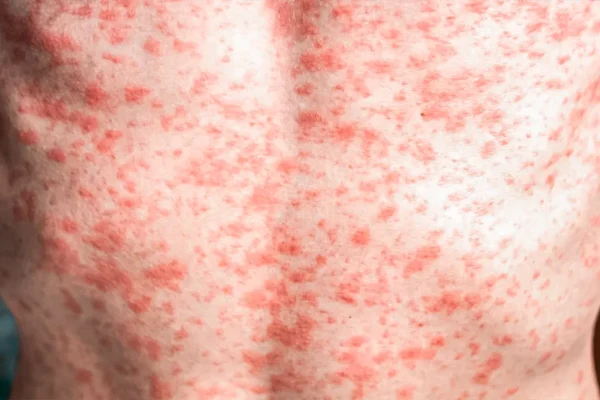 are-you-protected-against-measles-what-experts-want-you-to-know