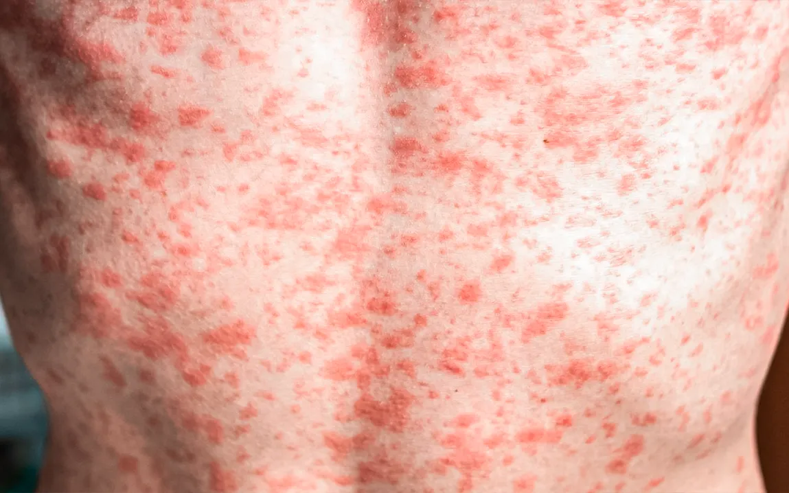 are-you-protected-against-measles-what-experts-want-you-to-know