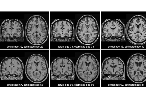 identifying-cognitive-decline-in-midlife-the-potential-of-brain-imaging