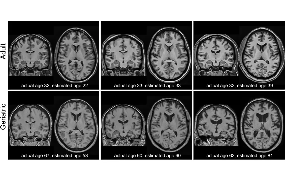 identifying-cognitive-decline-in-midlife-the-potential-of-brain-imaging