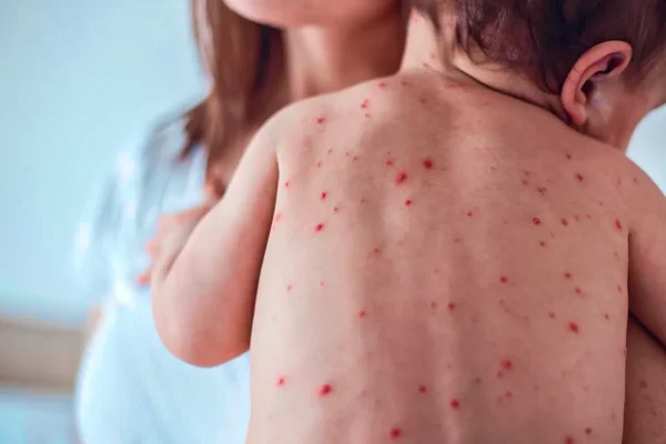 measles-outbreak-texas-new-mexico-escalates-raising-alarm-vaccine-hesitancy