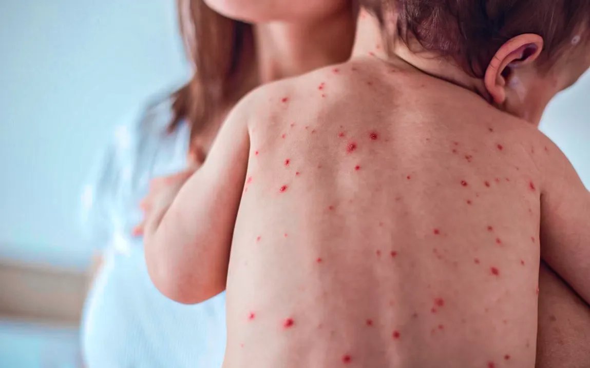 measles-outbreak-texas-new-mexico-escalates-raising-alarm-vaccine-hesitancy