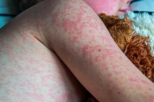 Measles Outbreak in North Dakota Grows 5 New Cases Confirmed in Williston