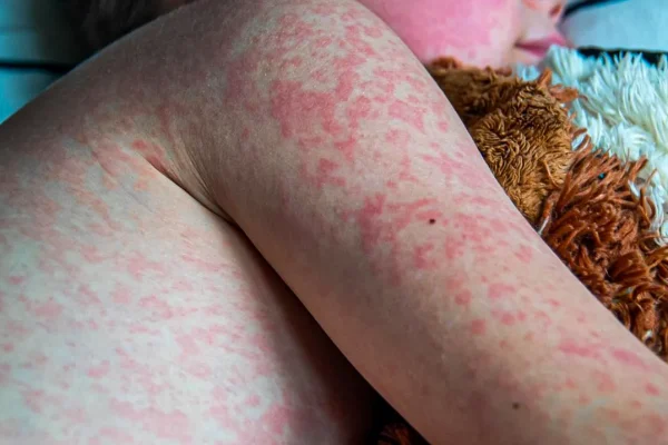 Measles Outbreak in North Dakota Grows 5 New Cases Confirmed in Williston