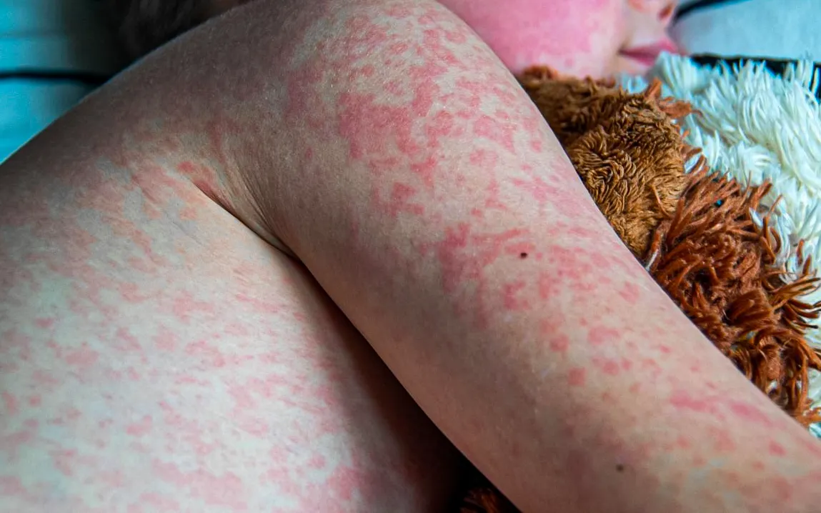 Measles Outbreak in North Dakota Grows 5 New Cases Confirmed in Williston