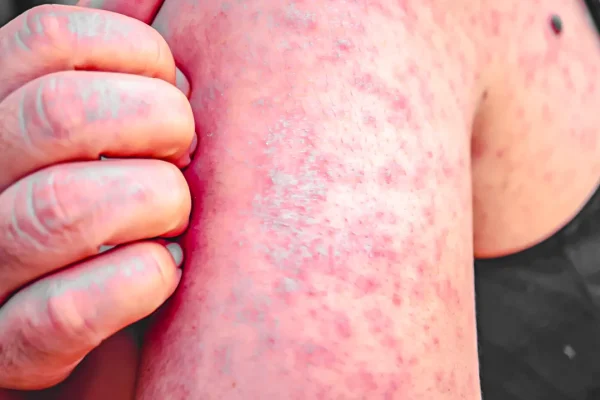 Measles Surge in U.S. Hits 1,000 Cases,
