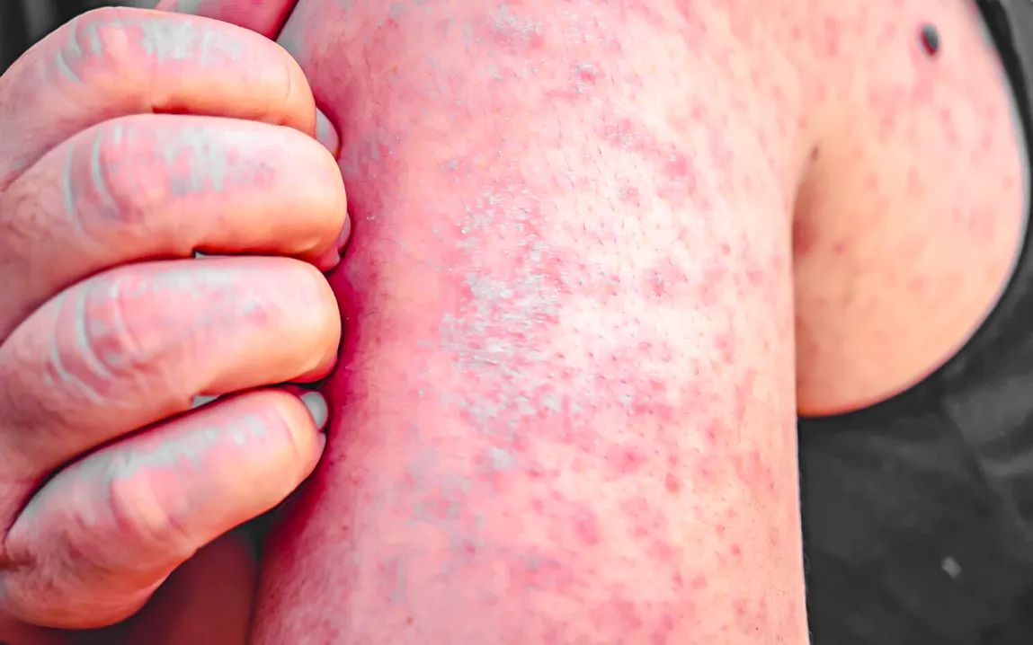 Measles Surge in U.S. Hits 1,000 Cases,